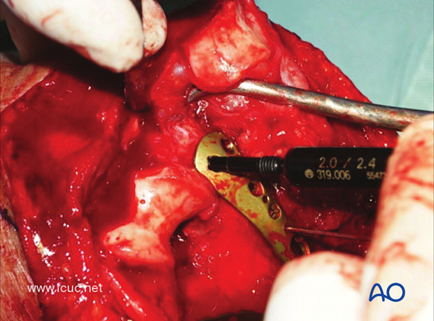 When drilling this back to front screw, the surgeon must be careful not to penetrate the capitellar joint surface but should be as deep as possible with the screw length, especially in osteoporotic bone.