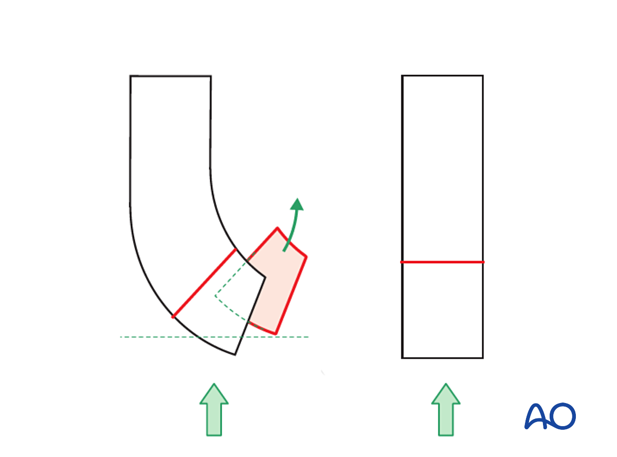 Splint Immobilization For Extraarticular, Simple Oblique Fracture