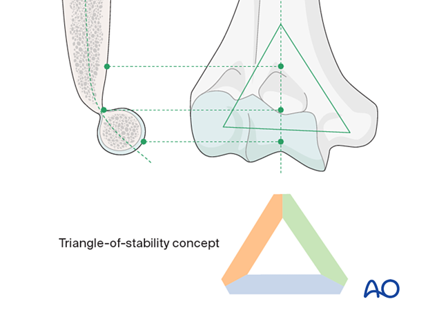 The mechanical properties of the distal humerus are based on a triangle of stability, comprising the medial and lateral columns and the articular block.