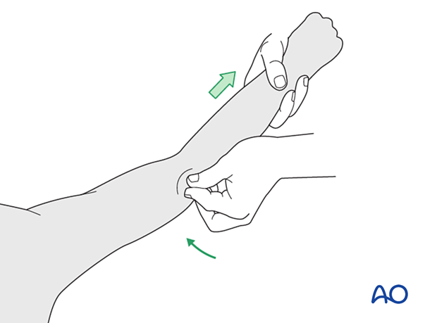 Reduction of the fracture fragment is obtained by manipulating it into its appropriate position.