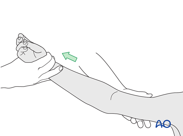Apply gentle manual traction to the arm with one hand and palpate with the other hand the bony eminences of the distal humerus, ie, medial and lateral epicondyles.