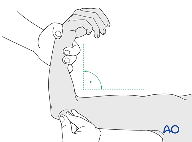 Flex the elbow up to 90°, while maintaining the reduction, and apply the posterior splint.