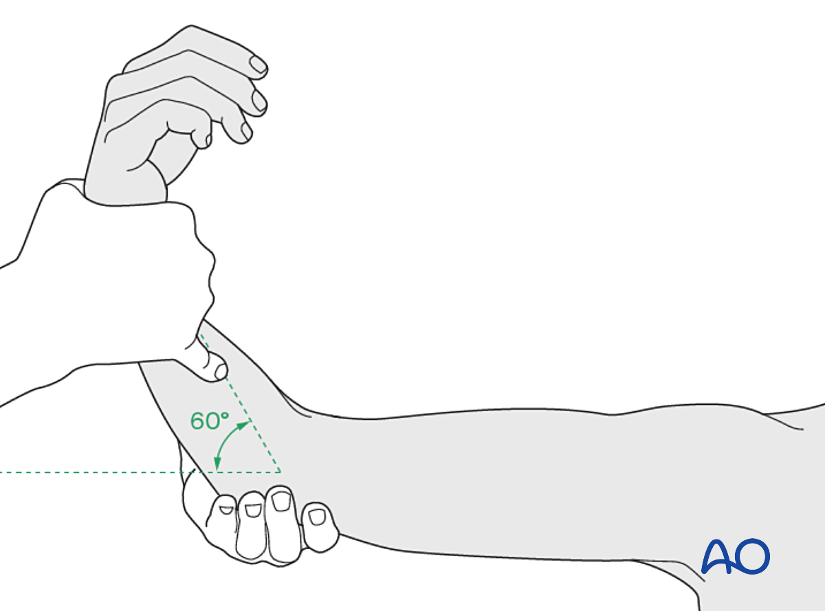 Splint Immobilization For Extraarticular, Simple Oblique Fracture