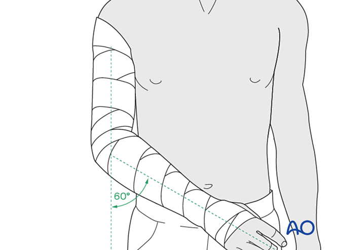 Splint immobilization for Complete articular fracture, simple articular ...