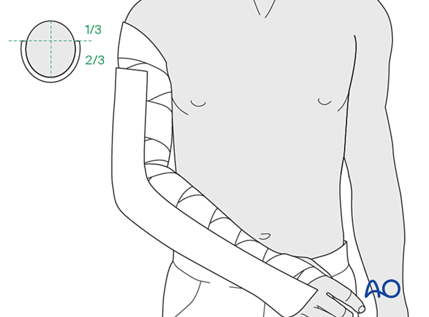 Apply a splint of fiberglass or plaster on the posterior aspect of the arm and forearm.