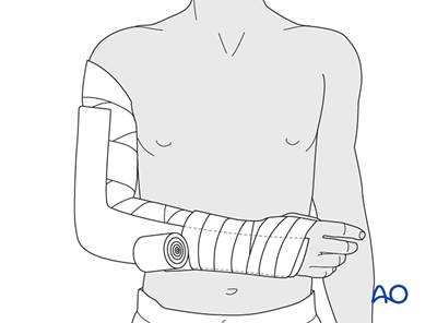 Splint immobilization for Avulsion of medial epicondyle