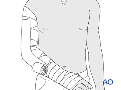 Splint Verbindung Splint immobilization for Complete articular fracture, simple articular ...