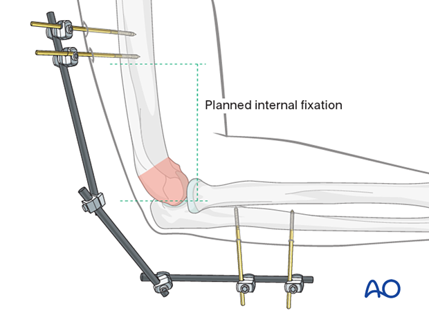 For temporary stabilization with an external fixator, the pins should be outside the planned internal fixation zone.