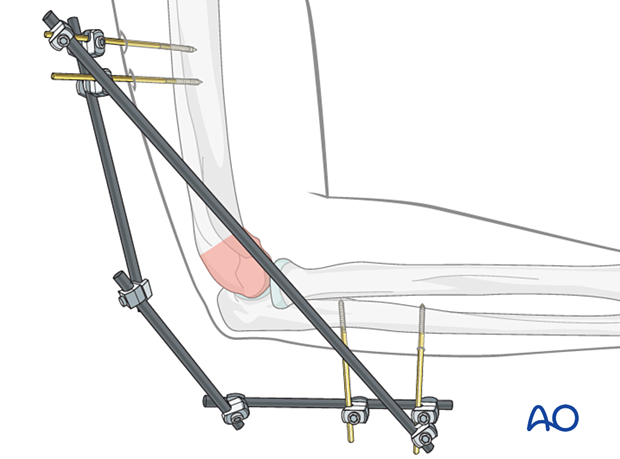 A rod can be added for additional stability, spanning from the most proximal to the most distal pin.