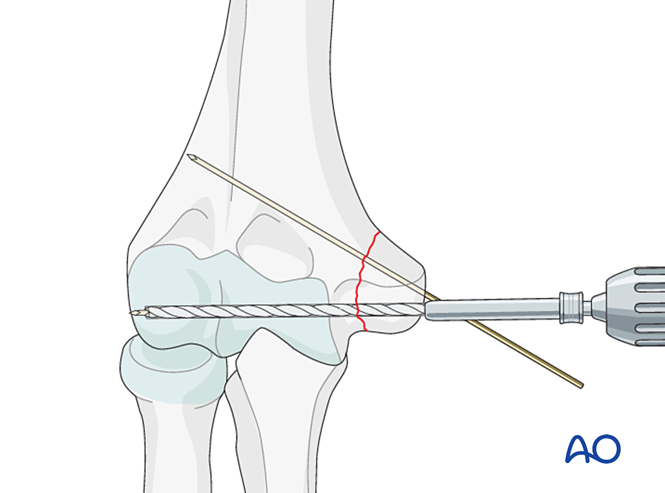 ORIF - Screw fixation for Avulsion of medial epicondyle