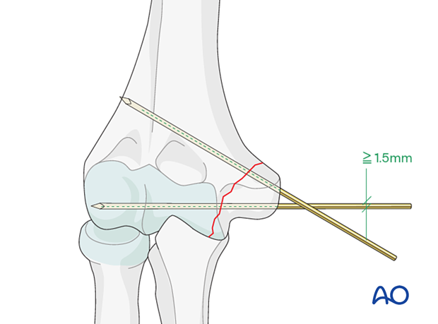 Preliminary K-wire fixation