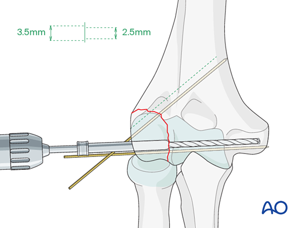 Drilling for lag screw fixation with a fully threaded screw, overdrilling the near fragment