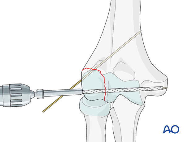 Drilling for insertion of a cannulated screw