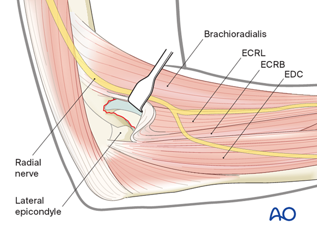 Lateral approach with splitting the interval between the ECRB and the EDC