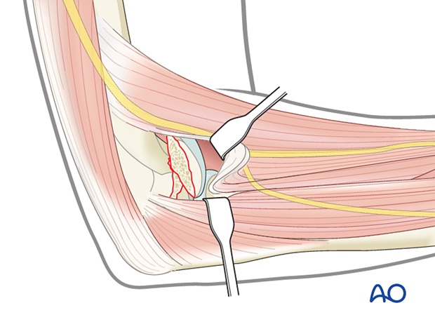 Exposure of the capitellar fracture