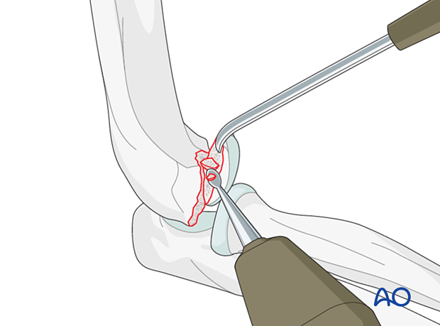 Clearing the capitellar fracture site from hematoma, loose pieces of bone, or imposed tissue