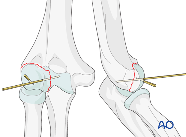 Temporary K-wire fixation of capitellar fracture