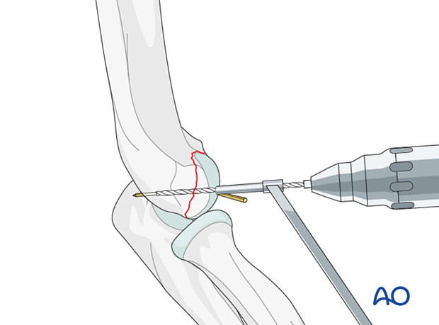 Drilling for headless screws