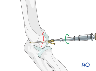 ORIF - Headless screw fixation for Partial articular fracture in ...