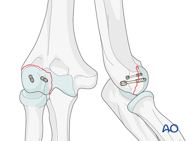 Fixation of capitellar fracture with posterior screw insertion