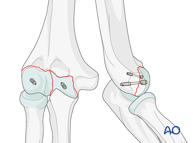 Headless screw fixation of capitellar and trochlear fracture