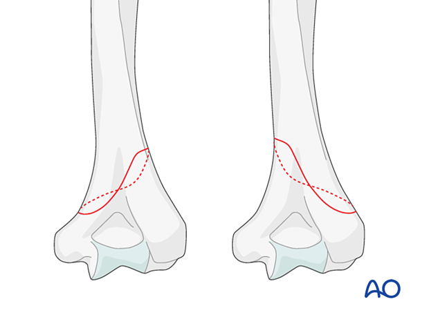 Obliquely distal and medial and obliquely distal and lateral fracture pattern