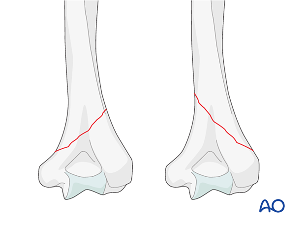 Obliquely distal and medial and obliquely distal and lateral fracture pattern