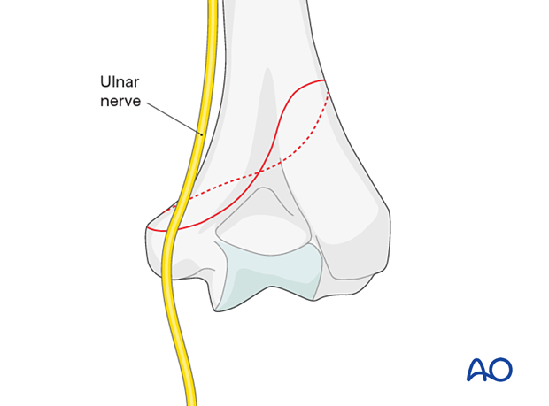 Ulnar nerve at risk if the fracture exits just above the medial condyle