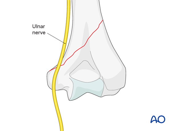 Ulnar nerve at risk if the fracture exits just above the medial condyle