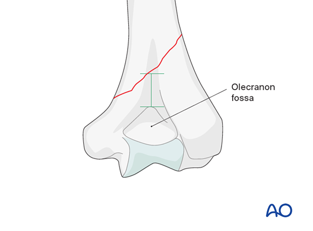 This construct is only possible if there is sufficient bone proximal to the olecranon fossa to apply a lag screw.