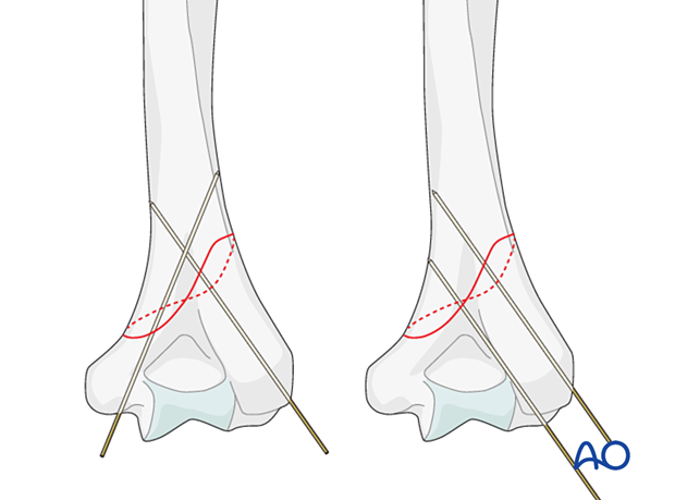 Preliminary fixation with axial K-wires