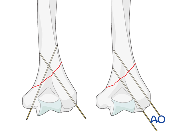 Preliminary fixation with axial K-wires