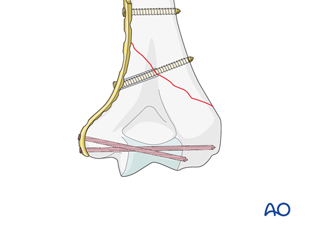 Medial plate application