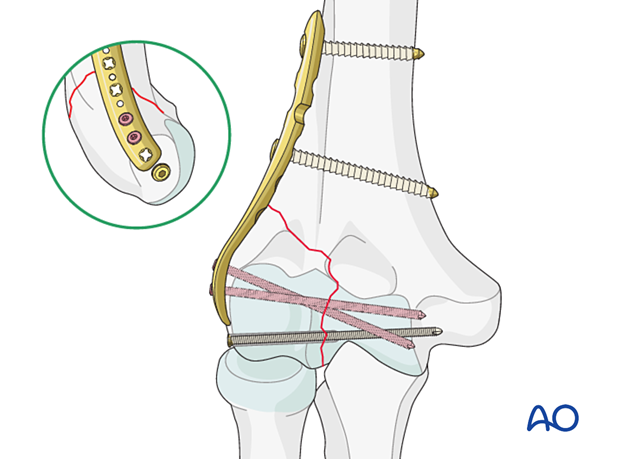 Fixation with lateral plate and independent lag screw