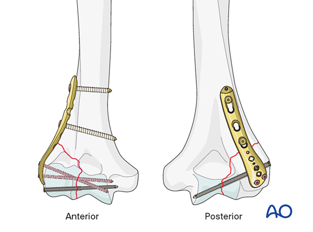 Lag screw fixation with lateral or dorsolateral plate