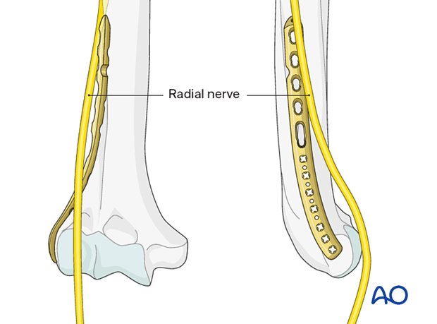 Radial nerve at risk with longer lateral plate