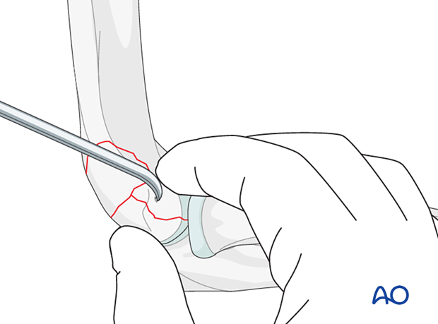 Direct fracture reduction