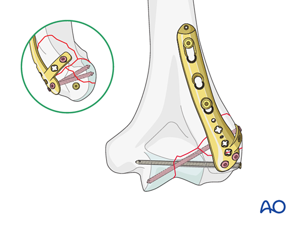 Fixation with dorsolateral plate and independent lag screw