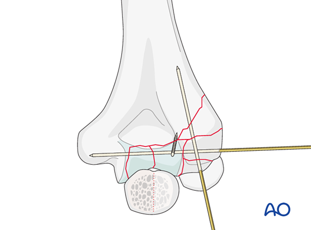 Provisional fixation of the articular segment
