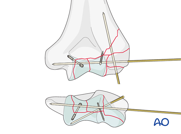 Fixation of articular fragments with buried headless screws, small threaded K-wires, or absorbable pins 