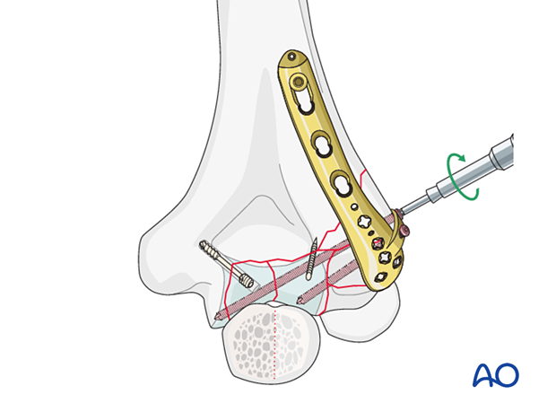 Screw insertion through the lateral tab into the articular segment