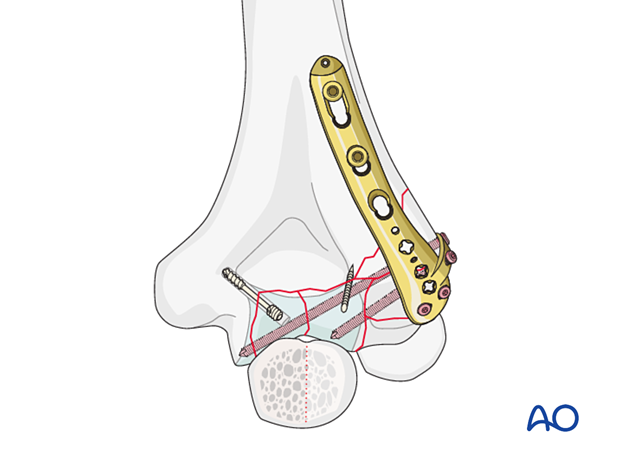 ORIF - Headless screw and dorsolateral plate fixation of fracture with complex osteochondral fragments