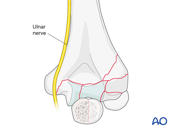 Ulnar nerve at risk if if the fracture exits just above the medial condyle
