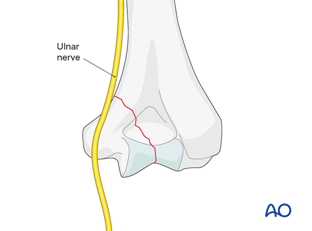 Ulnar nerve exposure and protection