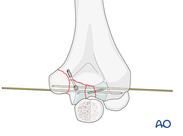 Fixation of articular fragments with buried headless screws, small threaded K-wires, or absorbable pins