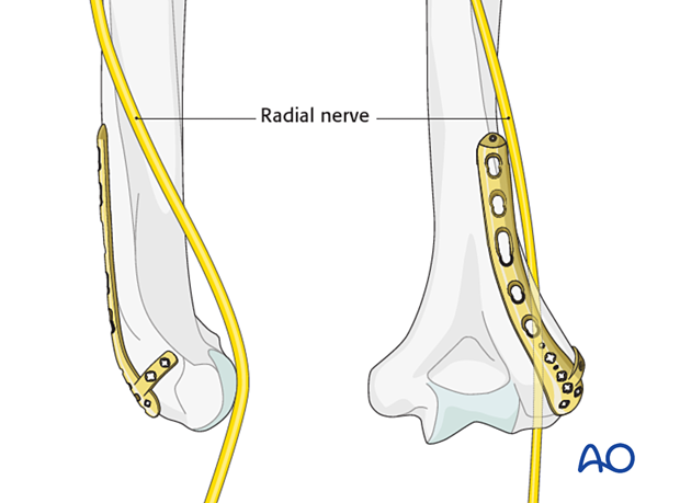 Radial nerve at risk with longer dorsolateral plate