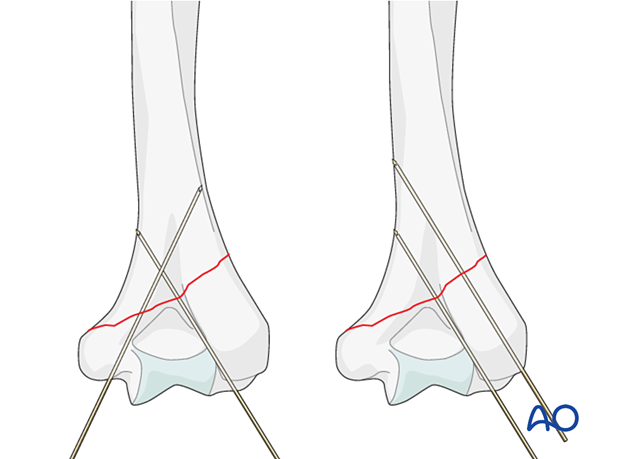 Preliminary fixation with axial K-wires