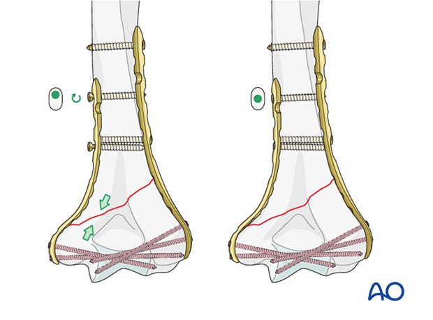 Medial plate application in either compression or neutral mode