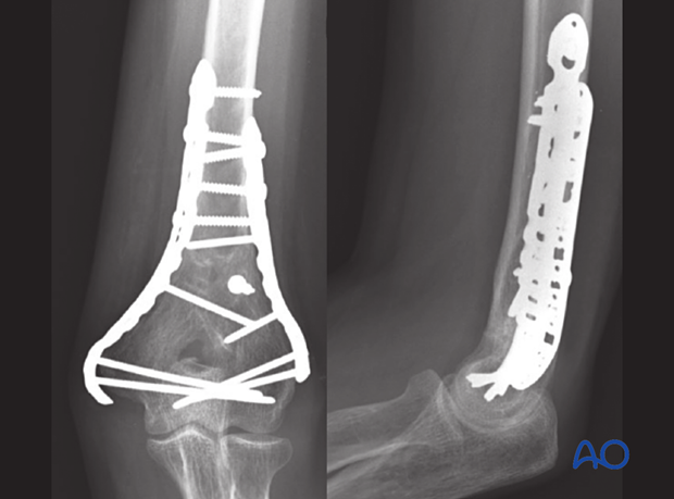 AP and lateral view of an extraarticular oblique fracture of the distal umerus with parallel bicolumnar plate fixation