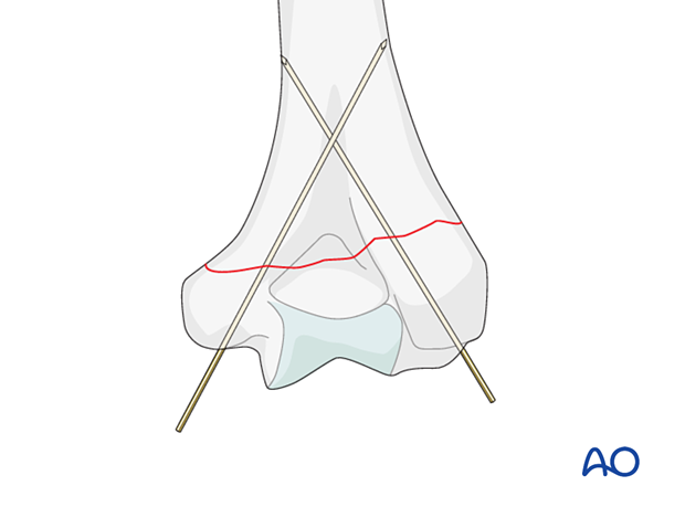 Temporarily holding the reduction with two K-wires introduced from the distal fragment into one or both columns